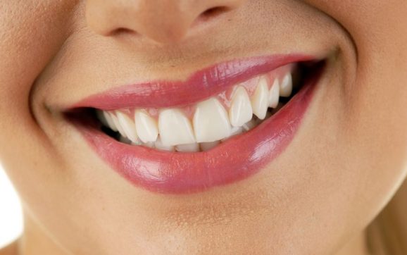 5 Things You Should Remember If You’re Getting Veneers