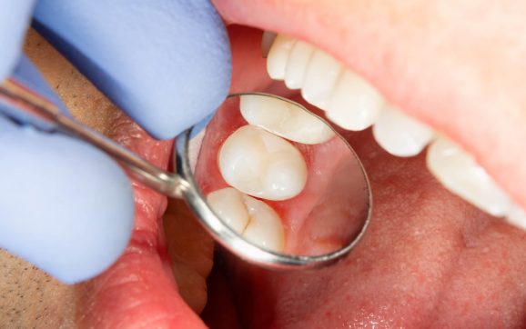 Enjoy Comfort as You Begin Your Invisalign Experience in Lakeview