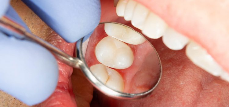 Enjoy Comfort as You Begin Your Invisalign Experience in Lakeview