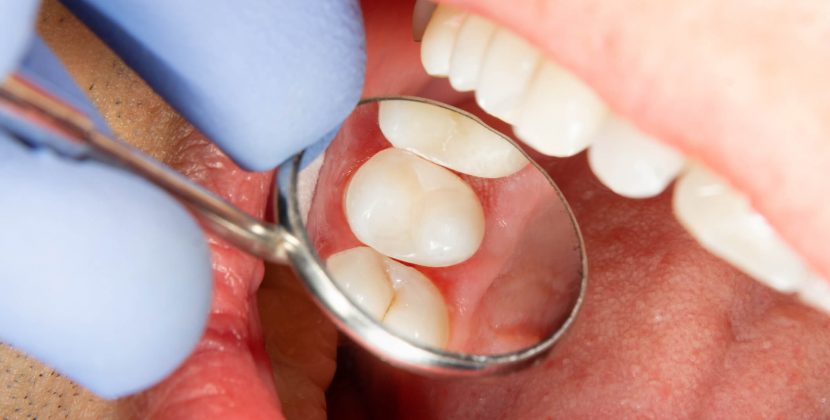 Enjoy Comfort as You Begin Your Invisalign Experience in Lakeview
