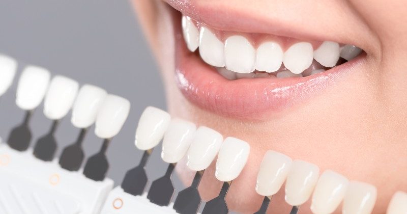 Answers to Commonly Asked Questions Concerning Cosmetic Dentistry